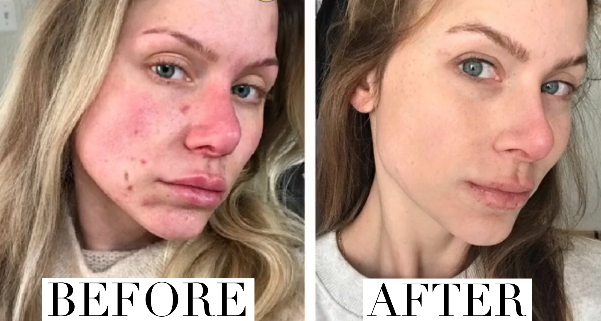 Accutane. My Experience. – Taylor Bee